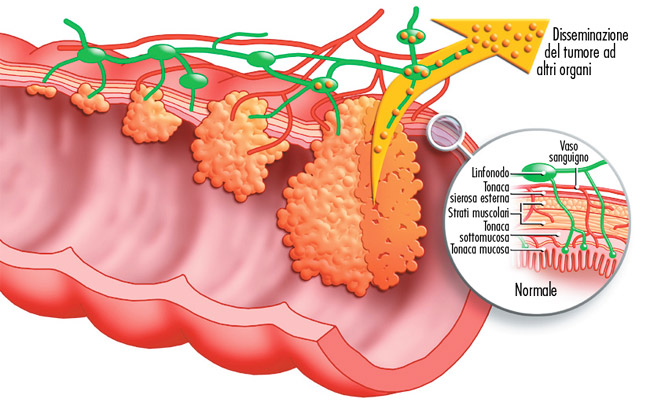 I tumori del maschio: allarme colon-retto